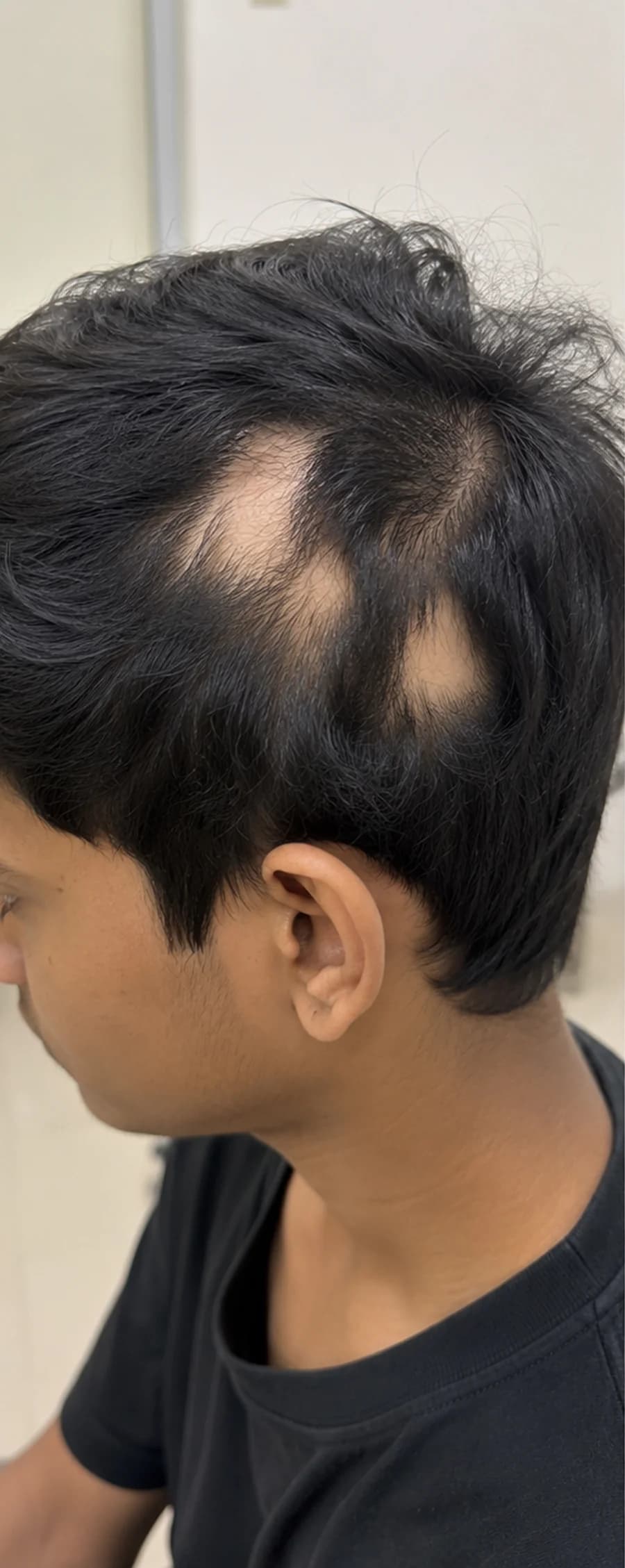 Patchy Hair Loss before treatment