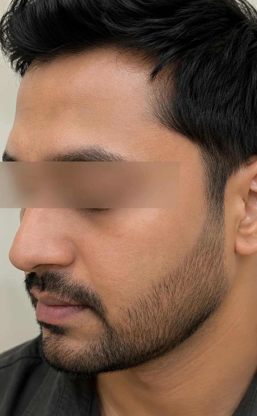 Dull, Uneven Skin after treatment