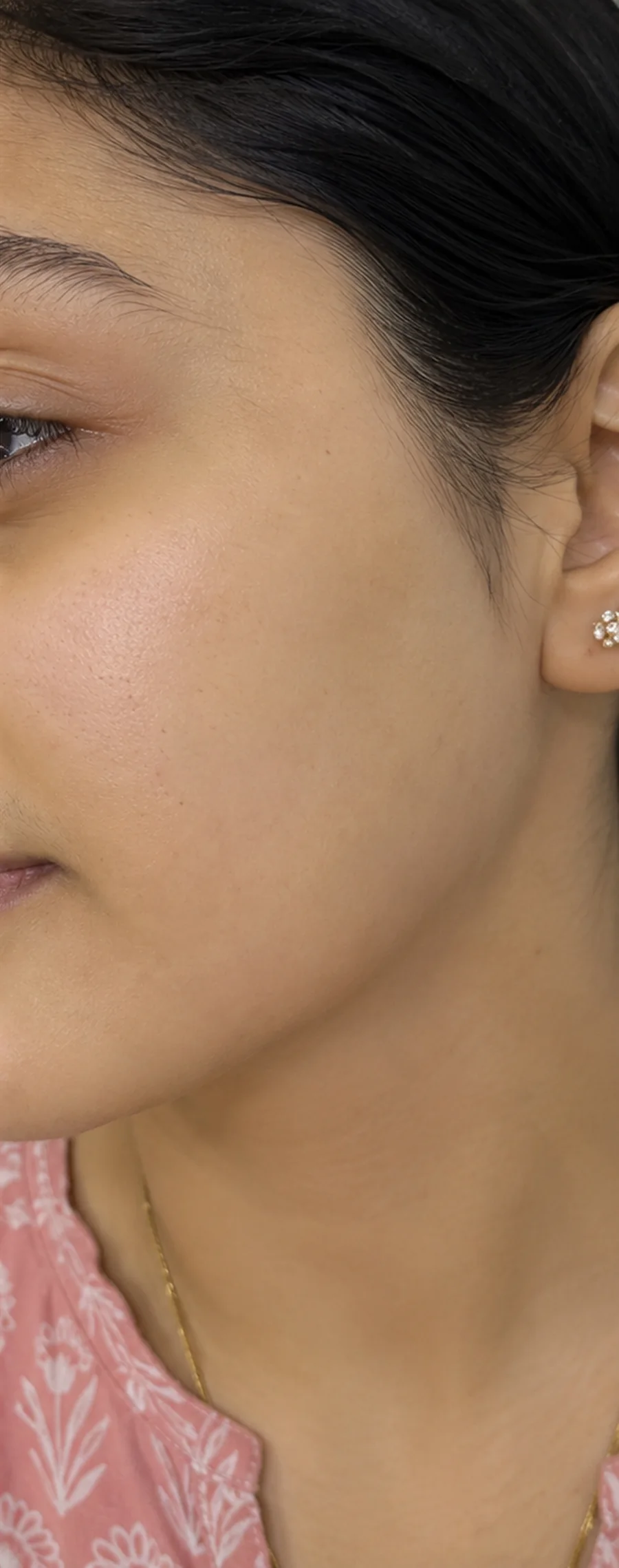Unwanted Facial Hair after treatment