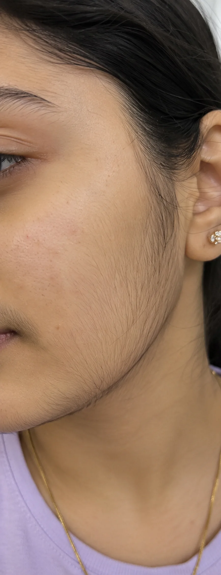 Unwanted Facial Hair before treatment
