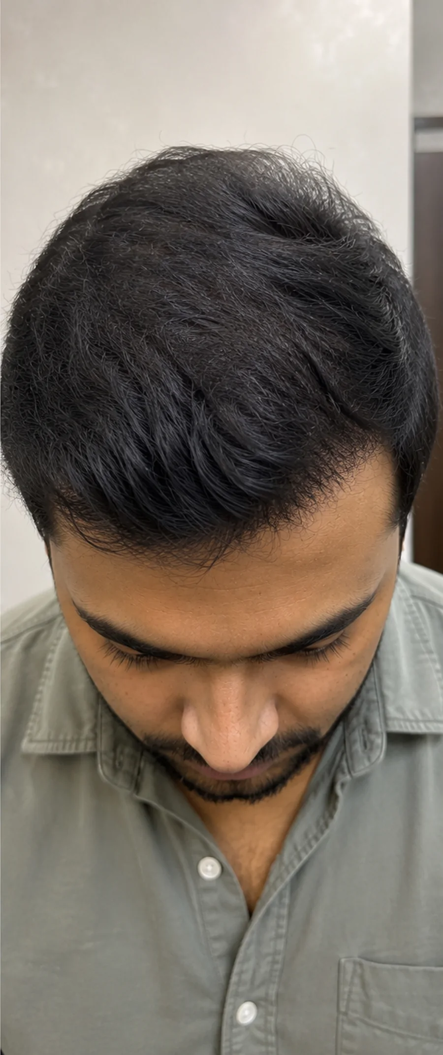 Hair Fall after treatment