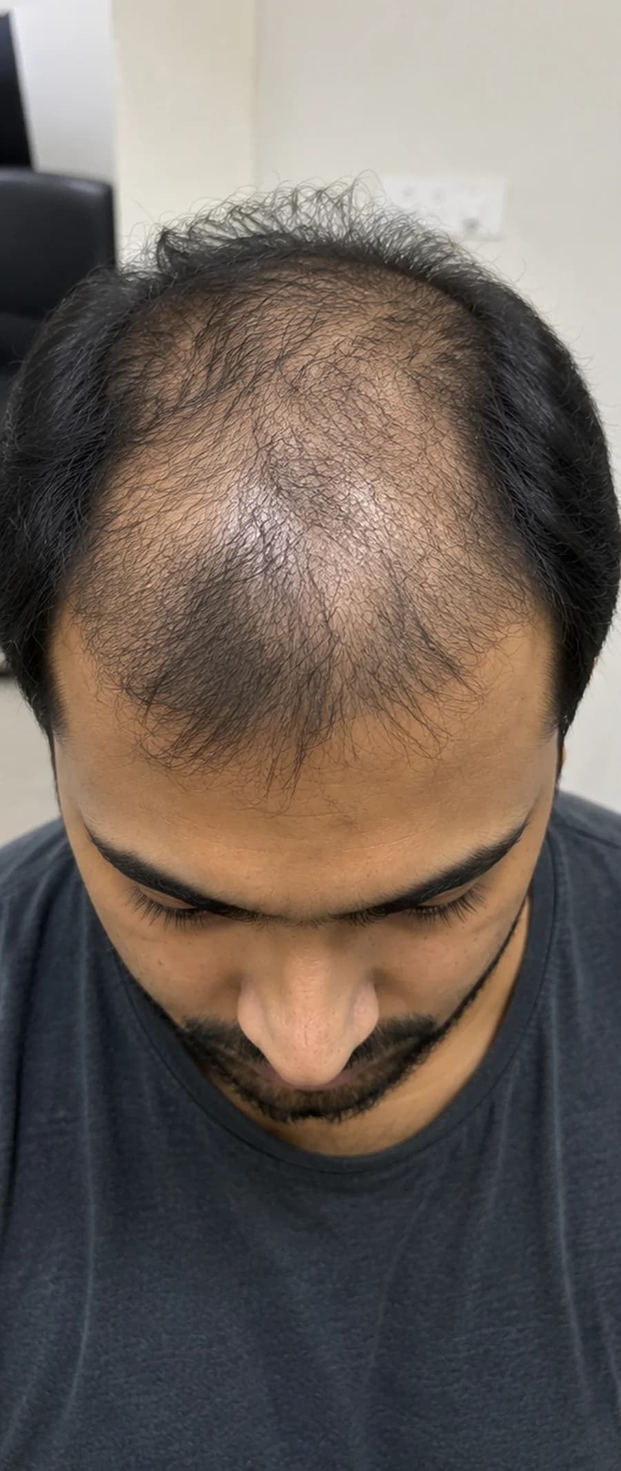 Hair Fall before treatment